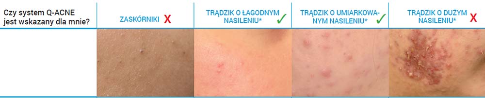 Rodzaje trądziku